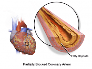 Angina HA Training Angina HA Training